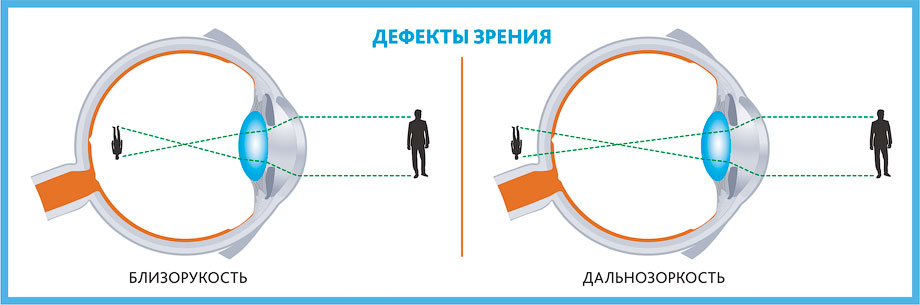 Глаз как оптическая система дефекты зрения и способы их исправления презентация