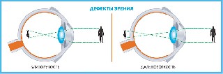 Дефекты зрения   Лазерная коррекция зрения при близорукости и дальнозоркости